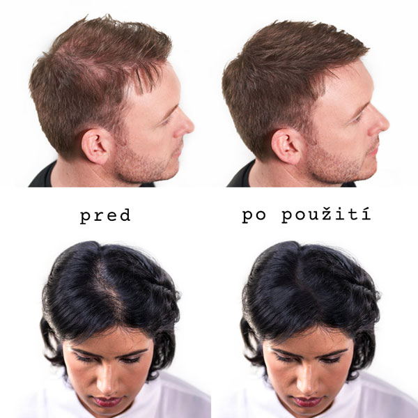 muž a žena pred a po použití keratínových vlákien od nanogen
