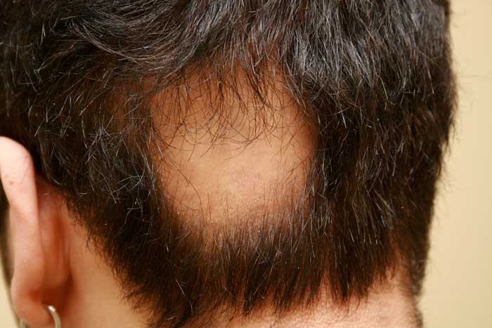 alopecia areata ochorenie