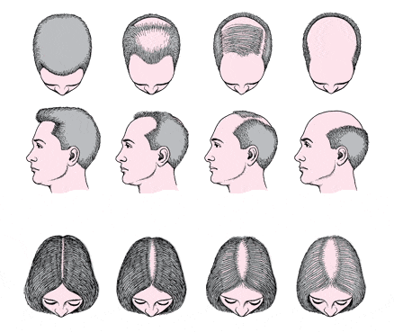 alopecia gif